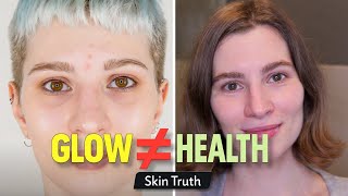 Glowy Skin Is Not Healthy Skin Heres Why