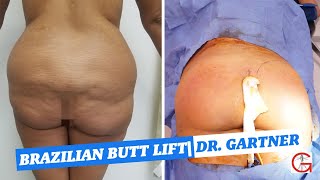 Before and After Brazilian Butt Lift| BBL| Liposuction| Dr. Gartner| Gartner Plastic Surgery