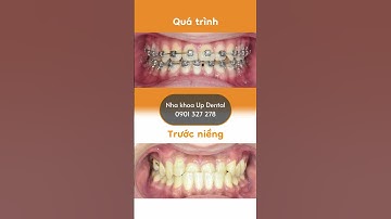 Hành trình LỘT XÁC nhờ niềng răng của Thiện Nhân