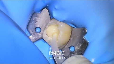 Primary molar pulpotomy and SSC