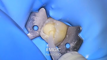 Primary molar pulpotomy and SSC