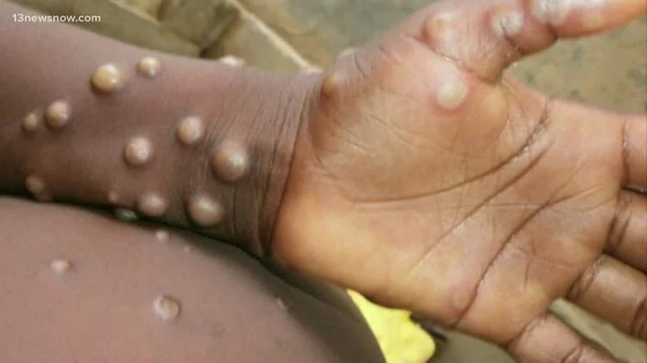 What you need to know about the monkeypox outbreak - DayDayNews