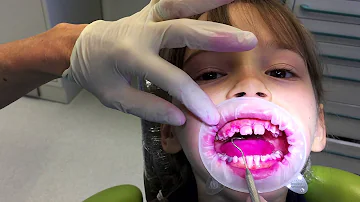 Quando si raddrizzano i denti?