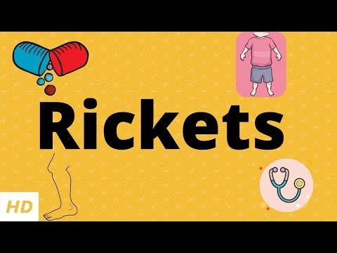 Video: Rickets - Tegn, Symptomer Og Behandling