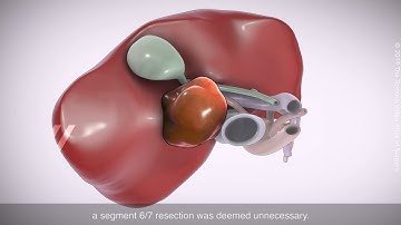 Laparoscopic segment 5 tumorectomy