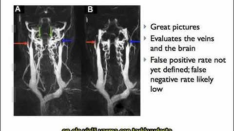 Johdanto CCSVI:hin Gary Siskin:in esittämänä, tekstitetty suomeksi.