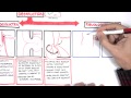 Bowel Obstruction - Causes and Pathophysiology