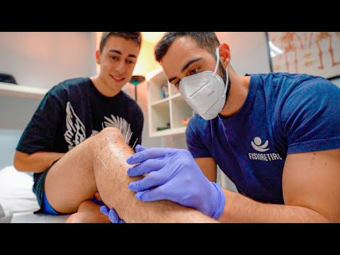 ¿Realmente funciona la ACUPUNTURA? | Mi recuperación de tobillo...🦶🏻📌