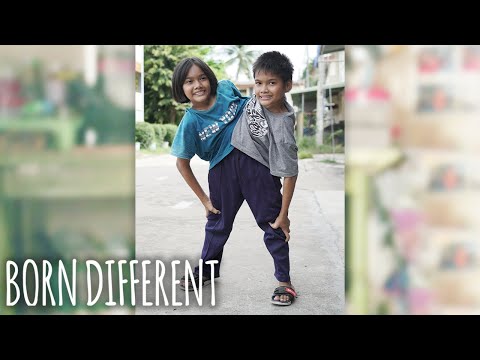 The Conjoined Twins Who Don't Want To Separate | BORN DIFFERENT