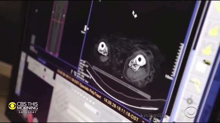 3D printed vocal Chords