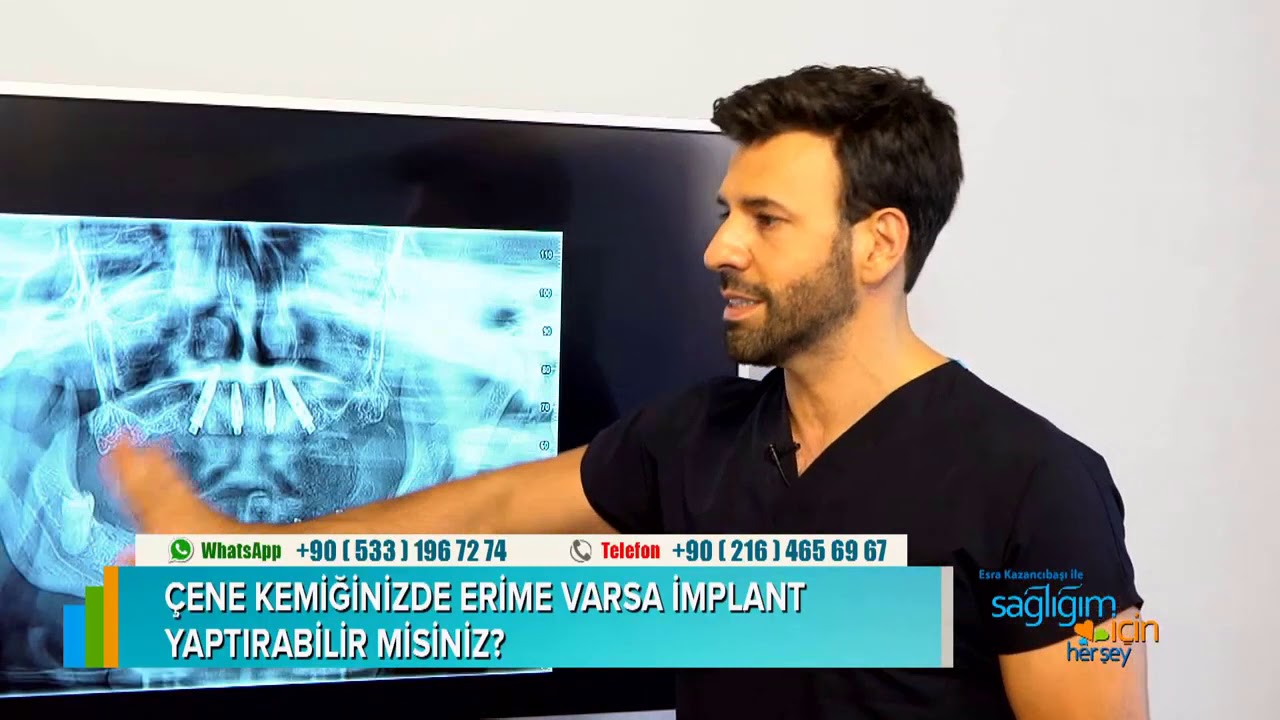 Çene Kemiğinizde Erime Varsa İmplant Yaptırabilir misiniz?