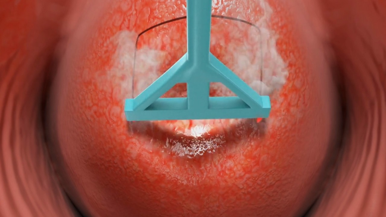 Loop Electrosurgical Excision Procedure LEEP 3D Animation YouTube loop-electrosurgical-excision-procedure-leep-3d-animation-youtube