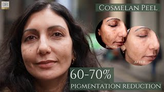 Cosmelan Peel 6 months Journey update with 70% pigment reduction!!!