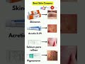 Best Skin Creams for Clear &amp; Glowing Skin || Skinoren Acretin, Sebium Pigmanorm Review