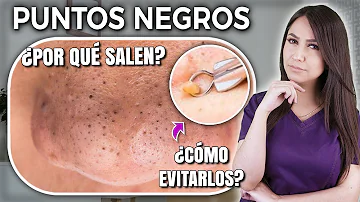 ¿Qué son los puntitos negros en la piel?
