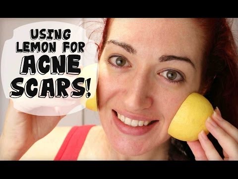 FADE ACNE SCARS WITH LEMON! Naturally Lighten Skin At Home! *UPDATED!*