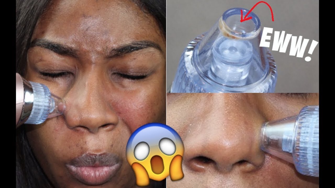 How to remove Blackheads Blackheads Vacuum YouTube