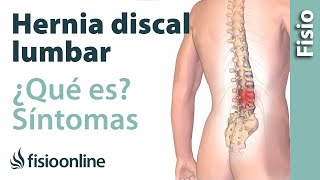 Hernia discal o de disco lumbar - Qué es, causas, síntomas y tratamiento