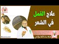 علاج القمل في الشعر الدكتور عماد ميزاب 