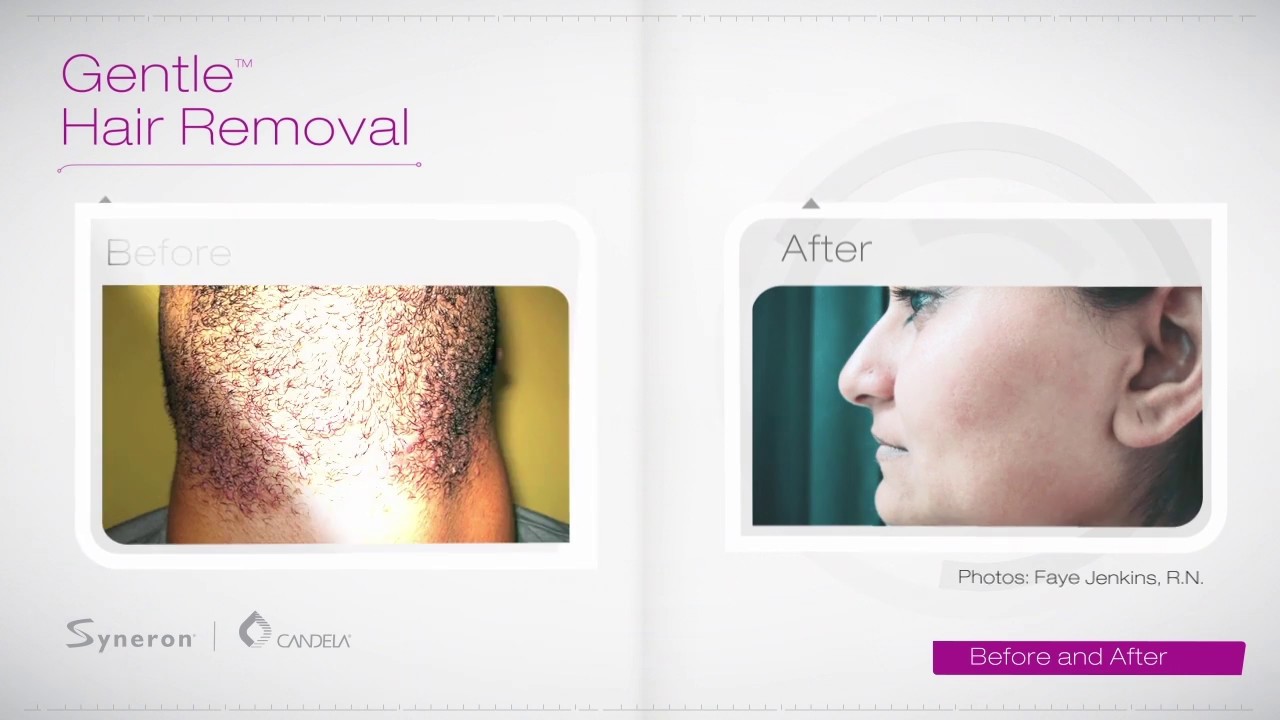 depilacion laser, depilacion, alexandrita, soprano , gentlemax pro