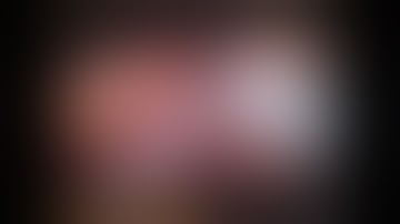 Robotic Left Hepatectomy