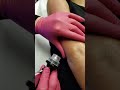 Dermalinfusion Hydrofacial on arms