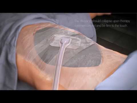 RENASYS◊ Abdominal Kit with Soft Port