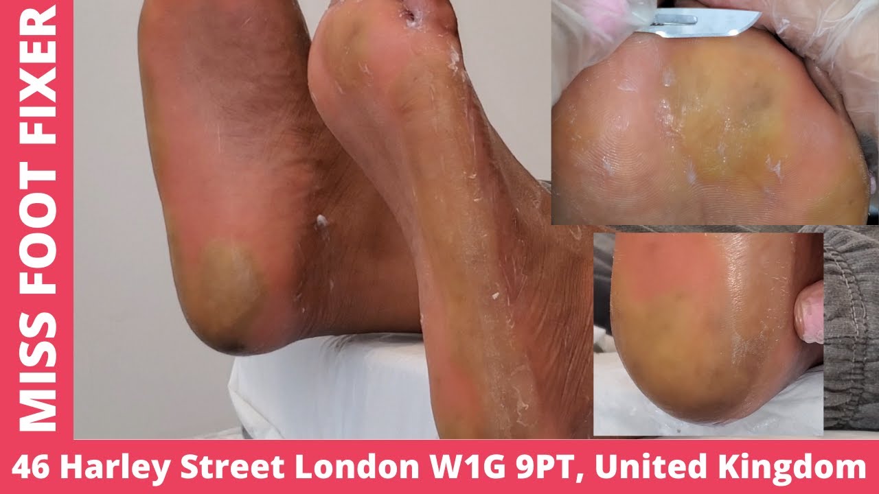 SATISFYING CALLUS! CALLUS ! CALLUS REMOVAL [ PART 1] BY MISS FOOT