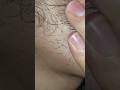 Satisfying #massage therapy #ingrownhair #haircare #relax #hairgrowth #shorts #video #viral #hair