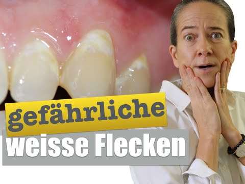 Video: Ursachen Für Weiße Flecken Auf Den Zähnen