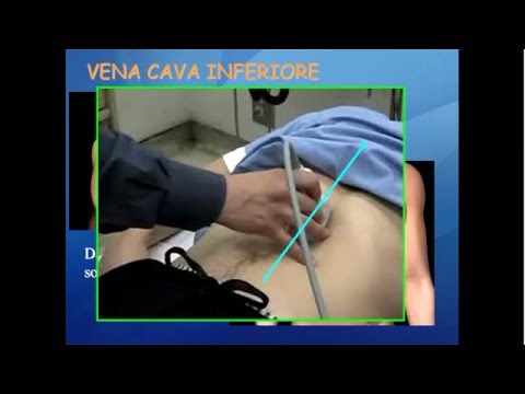 Video: Vena Cava Inferiore - Diametro, Trombosi, Compressione