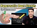 Pancreatic Duct Stones in Ultrasound | Ultrasound Training Video by Dr Ali Waqar