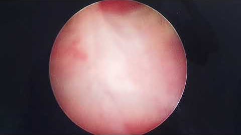 Lý do nào để thận giãn to?  TTƯT.TS.BS.Dương Văn Trung ☎️0913534343, website:soithan.net.vn