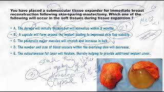 Tissue Expander Soft Tissue effect and capsule formation - Plasticology Shots screenshot 5