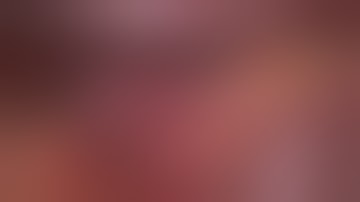 Asvide: Laparoscopic D2 dissection for locally advanced gastric cancer in China