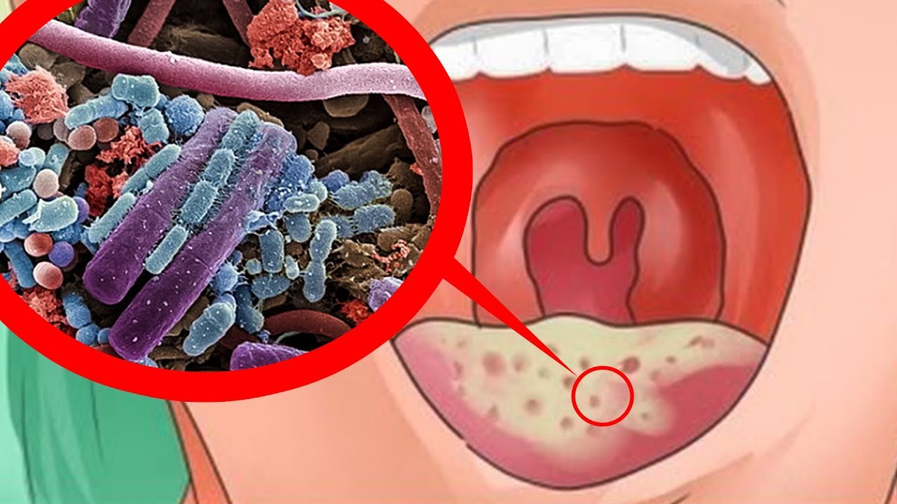 Грибок кандида изнашивает наш организм. Помогите себе пока не поздно ...