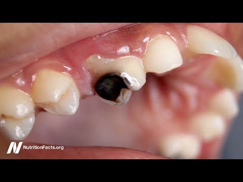Wideo: Jak kontrolować próchnicę w zębach?