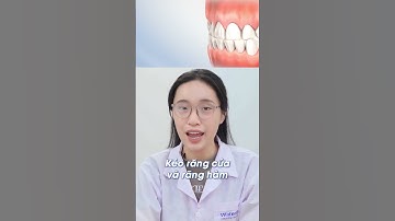 Tại sao răng số 4 thường được nhổ khi niềng