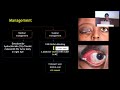 AIOC2024 Hyde Park   Pediatric Ophthalmology FP3038 Advanced Glaucoma in Unilateral Congenital Ectro