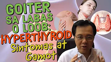 Goiter sa Labas o Loob. Hyperthyroid Sintomas at Gamot - Payo ni Doc Willie Ong #212