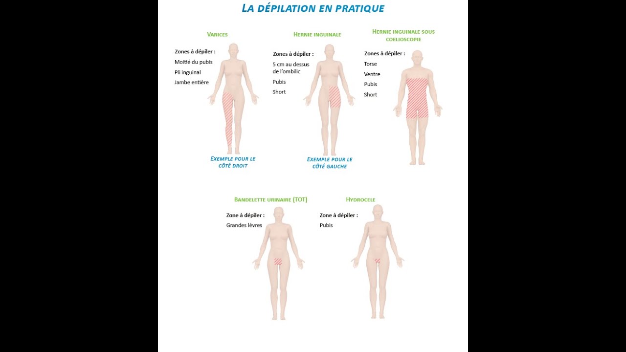 La dépilation avant une intervention YouTube