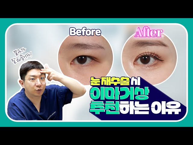 이마거상이 과잉진료라고요? ㅣ 성형페이퍼 ㅣ김형석 성형외과 전문의