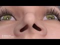 Pinched Narrow Nose Rhinoplasty to Address Nasal Obstruction