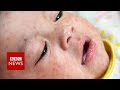 Why is there a measles outbreak in Europe? BBC News