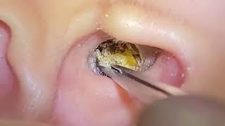 Asmr Ear Cleaning Youll Regret Skipping This Deep Clean