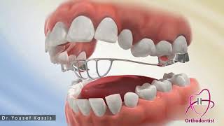 دكتور يوسف قصيص: جهاز كبح اللسان (تقويم الأسنان)...