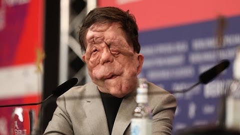 Adam Pearson: Disfigured Berlinale star wows at premiere