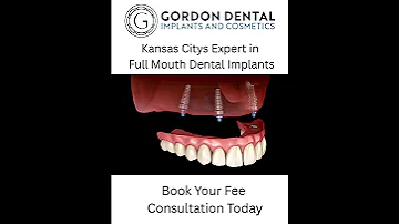 Full Mouth Dental Implants That Change Lives All On 4 Smile Transformation 
