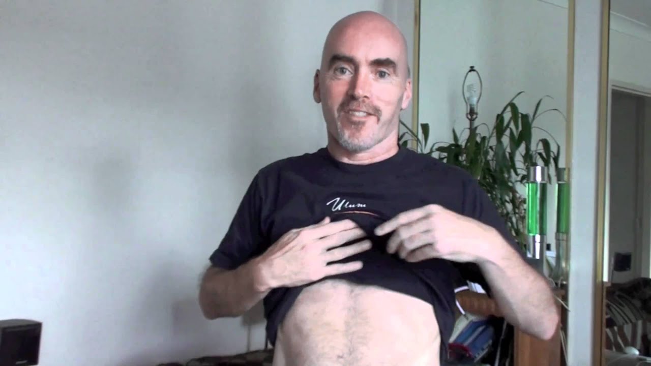 Laparoscopic Cholecystectomy GallBladder Surgery pre and post op