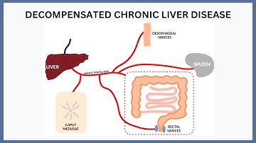 Decompensated Chronic Liver Disease Explained